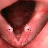 Etiopatogénesis de los nódulos vocales